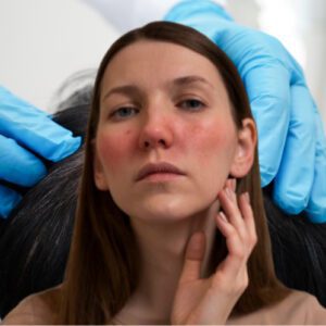 Rosacea