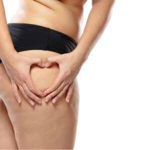 Cellulite